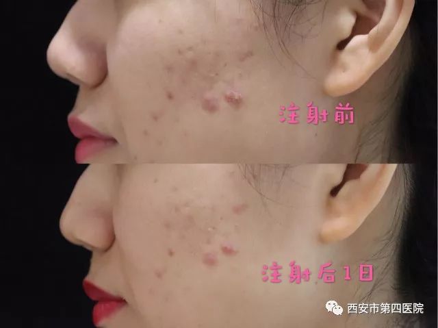 最新痤瘡治療技術(shù)，開(kāi)啟美麗肌膚之門